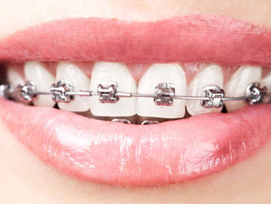 傳統(tǒng)托槽矯正