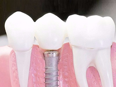 在承德口腔種植齒需要多少錢？惟德口腔一一為您道來